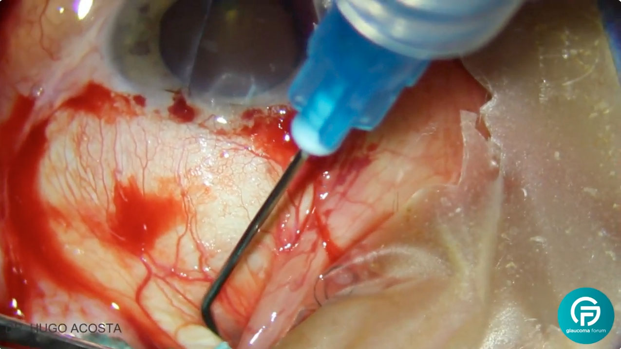 Dispositivos de Drenaje