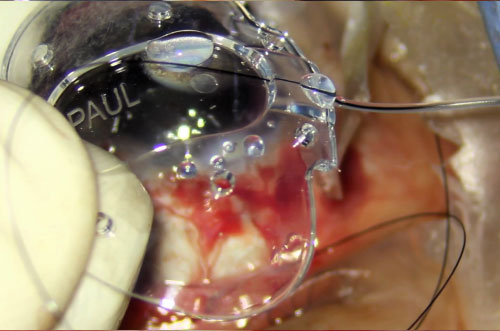 Dispositivos de Drenaje