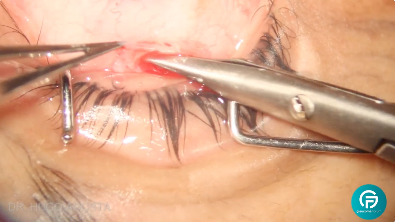 Curso de Trabeculectomía